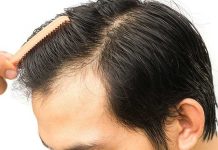 How Long Do Hair Transplant Last